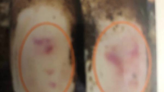 <p>Bruising is very common at calving ( and other wet periods ) and especially so in heifers. If you push on the sole it will easily push in. There is usually reddening patches.
Again usually it involves almost all the feet of the animal involved.</p>