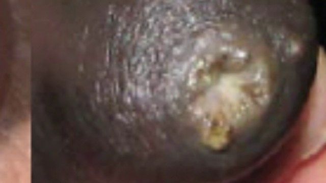 <p>Next you end up with a rough teat end like this. They can not only harbour bacteria but are also less protective.</p>
