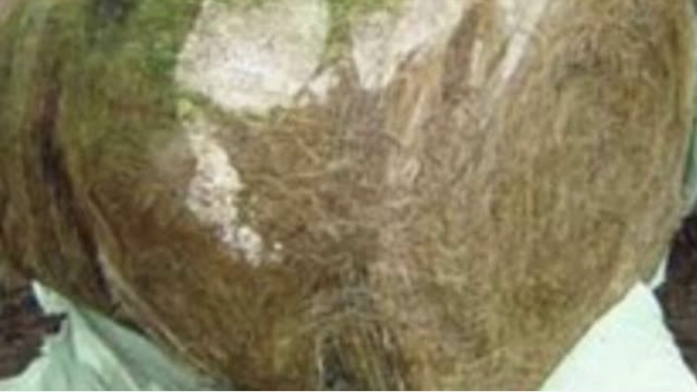 <p>Fungal abortion:
Abort from 4 months on.
Mouldy hay and silage.
Usually the foetus isn't rotten and often has grey ringworm like skin lesions on the head and shoulders.
Isolate fungi from placenta and foetus.</p>