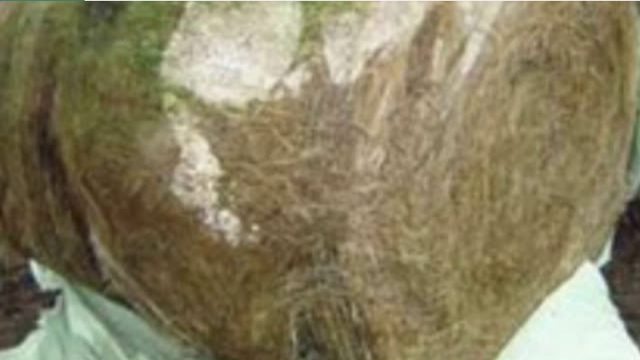 <p>Listeria:
From mouldy hay / silage usually.
At any stage of gestation.
Can be sporadic or mass outbreak.
Cow may have fever and not eat leading into it.
A rotten foetus and RFM is very common.
Culture from membrane or foetus.
white spots on cotyledon</p>
