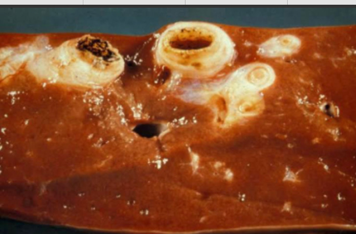 <p>This is the damage they cause in the liver.</p>
