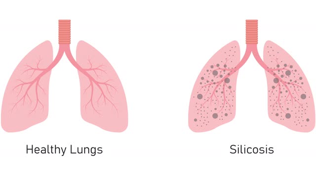 <p><strong>Understanding Silica Dust and Its Risks</strong>
Silica dust is a fine particulate matter found in materials like concrete, bricks, stone, and sand. Exposure to respirable crystalline silica (RCS) dust can cause serious health issues including silicosis, lung cancer, and chronic obstructive pulmonary disease (COPD).</p>