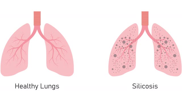 **Understanding Silica Dust and Its Risks**
Silica dust is a fine particulate matter found in materials like concrete, bricks, stone, and sand. Exposure to respirable crystalline silica (RCS) dust can cause serious health issues including silicosis, lung cancer, and chronic obstructive pulmonary disease (COPD).