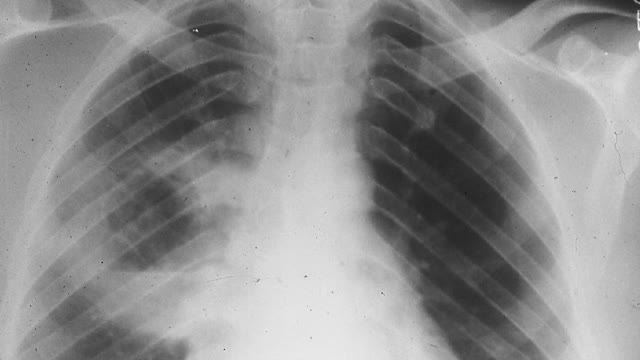 <h4>Exposure to respirable silica dust can lead to the development of:</h4>
<ul>
<li>Silicosis (an irreversible scarring and stiffening of the lungs)</li>
<li>Accelerated silicosis.</li>
<li>Progressive Massive Fibrosis (PMF)</li>
<li>Chronic Obstructive Pulmonary Disease (COPD) often observed as emphysema and bronchitis</li>
<li>Lung cancer</li>
<li>Kidney disease</li>
<li>Auto-immune diseases</li>
</ul>