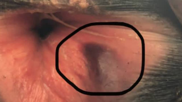 <p>There will often be bruising like this.</p>